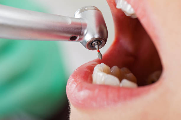 Best Emergency Root Canal Treatment in West Sharyland, TX